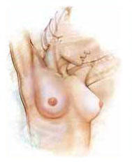 chicago-breast-augmentation-after