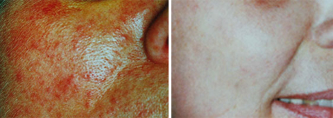 Skin Resurfacing