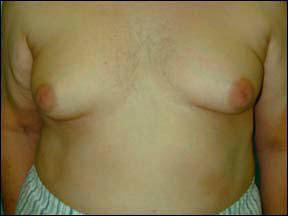 gynecomastia