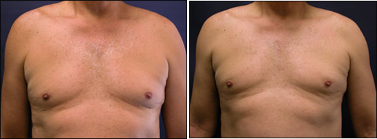 gynecomastia