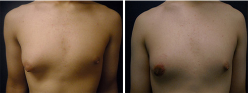 gynecomastia