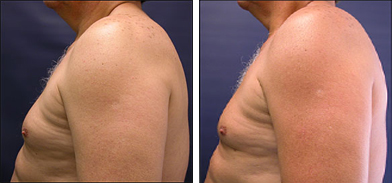 gynecomastia