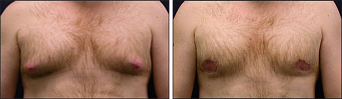 gynecomastia