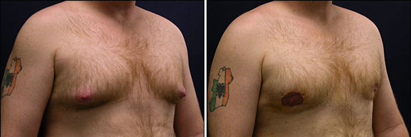gynecomastia