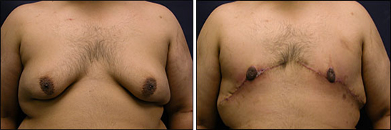 gynecomastia