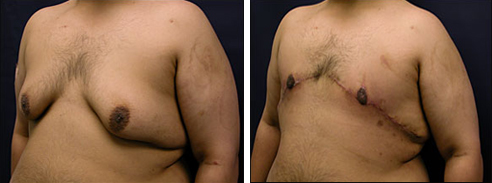 gynecomastia