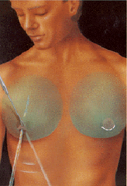 gynecomastia