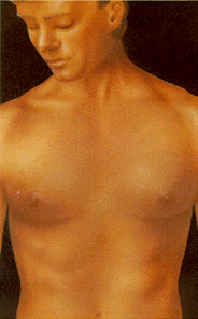 gynecomastia