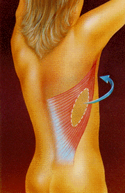 Flap reconstruction