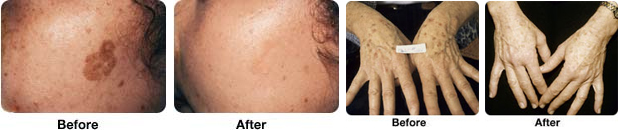 Laser Mole Removal