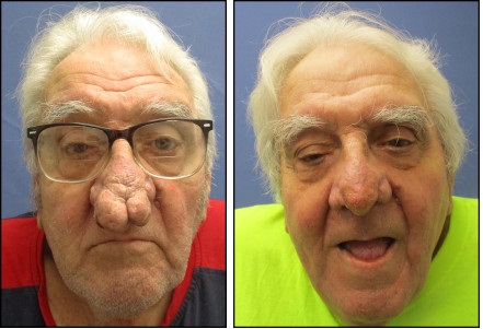 Rhinophyma Removal in Chicago | Prplastic