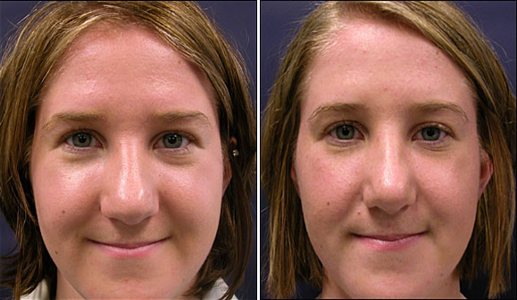 rhinoplasty