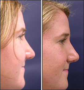 rhinoplasty