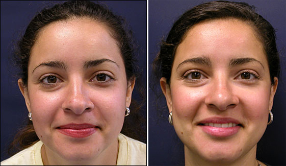 rhinoplasty