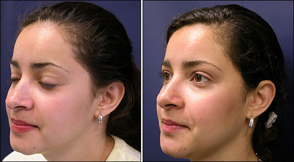 rhinoplasty