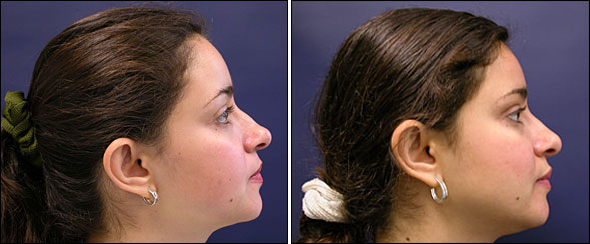 rhinoplasty