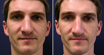 rhinoplasty