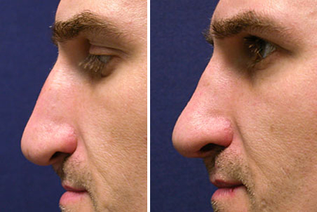 rhinoplasty