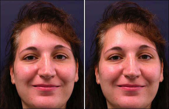 rhinoplasty