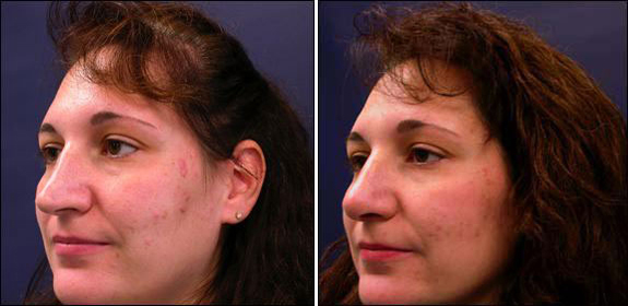 rhinoplasty