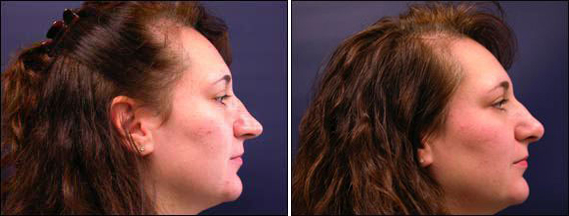 rhinoplasty