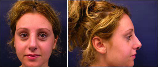 rhinoplasty