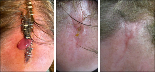 https://www.prplastic.com/images/scar%20treatment%20stiches%20and%20sutures.jpg