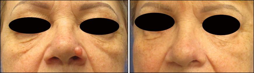 facelift