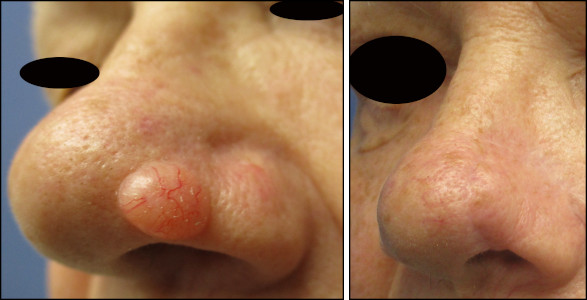 facelift