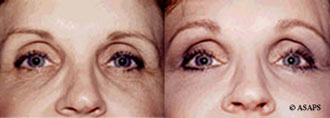 Photo Rejuvenation - Before and After