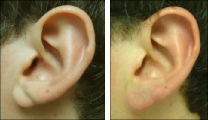 split ear lobes