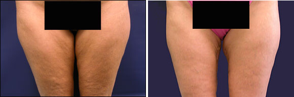 Thigh Lift Surgery Before and After Pictures