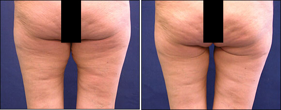 Thigh Lift Surgery Before and After Pictures, Scar Pictures