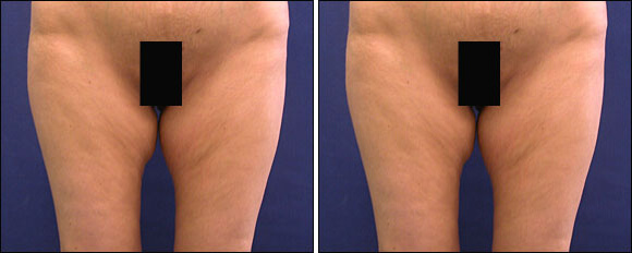 Thigh Lift Surgery Before and After Pictures