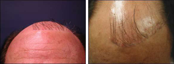 Hair Restoration and Transplant: Procedure, Complications, and patient  Before & After Pictures