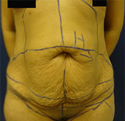 TummyTuck