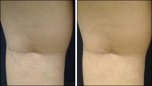 laser vein removal