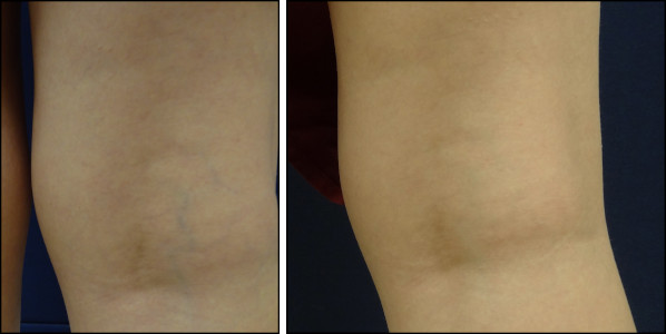 laser vein removal