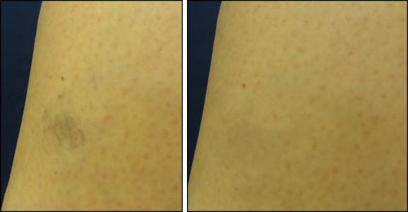 laser vein removal