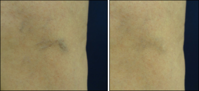 laser vein removal